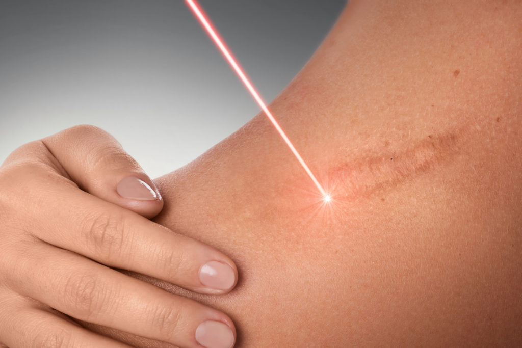 Trattamento laser cicatrici